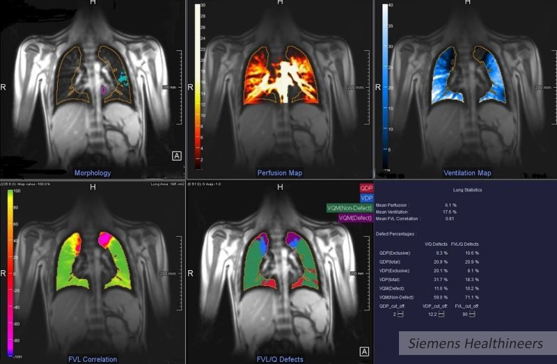 Uniwersytet Medyczny w Poznaniu i Siemens Healthineers razem w diagnostyce mukowiscydozy